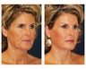 Facial Rejuvenation