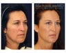 Cheek Augmentation