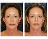 Cheek Augmentation