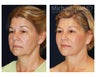 Cheek Augmentation
