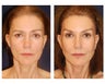 Cheek Augmentation