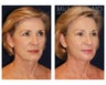 Cheek Augmentation