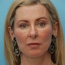 Under Eye Dermafiller, Cheek Dermafiller