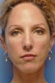 Cheek Dermafillers, Eye Dermafillers, Facial Dermafillers