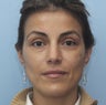 Cheek Dermafiller, Under Eye Dermafiller, Face Dermafiller