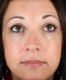 Cheek Augmentation with Hyaluronic Acid Filler