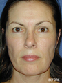 Cheek Impant Surgery