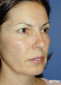 Cheek Implant Surgery