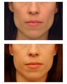 Cheek Augmentation