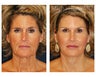 Facial Rejuvenation