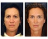 Cheek Augmentation