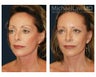 Cheek Augmentation