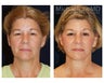 Cheek Augmentation