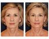 Cheek Augmentation