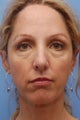 Cheek Dermafillers, Eye Dermafillers, Facial Dermafillers