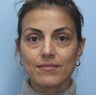 Cheek Dermafiller, Under Eye Dermafiller, Face Dermafiller