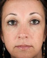 Cheek Augmentation with Hyaluronic Acid Filler