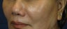 Cheek Lift / Augmentation