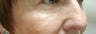 Lower eyelid and cheek lift