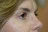 Midface lift, upper and lower eyelid surgery, Hetter resurfacing chemical peel