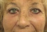 Lower Blepharoplalsty and Cheek Lift