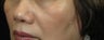 Cheek Lift / Augmentation