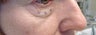 Lower eyelid and cheek lift