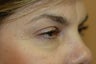 Midface lift, upper and lower eyelid surgery, Hetter resurfacing chemical peel