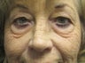 Lower Blepharoplalsty and Cheek Lift