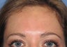 Chemical Peel ~ Vitalize