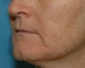 Chemical Peel