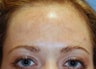 Chemical Peel ~ Vitalize