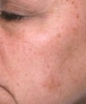 Melanage Peel to Treat Melasma and Hyperpigmentation