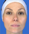 Chemical Peel