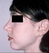 Rhinoplasty with Chin implant