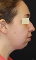 Liposuction face