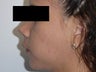 Chin Implants