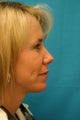 Chin Implant