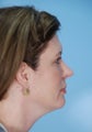 Revision Chin Implant