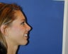 Chin Augmentation 