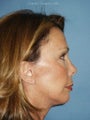 Chin augmentation with facial rejuvenation