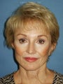 Chin augmentation with facial rejuvenation 