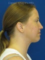 Chin implant Exchange for a more contemporary size medium chin implant and  Necklift with 15cc of VASER liposuction of the neck.