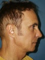  Chin augmentation, bilateral upper and lower blepharoplasty with canthopexy, and soft tissue fillers to the nasolabial folds 