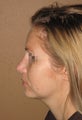 Chin enlargment and rhinoplasty combo