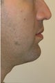 Chin augmentation, neck liposuction and neck muscle tightening.