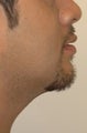 Chin augmentation, neck liposuction and neck muscle tightening.