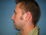 chin implant