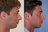 Chin Implant , Rhinoplasty