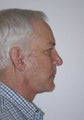 Chin Implant